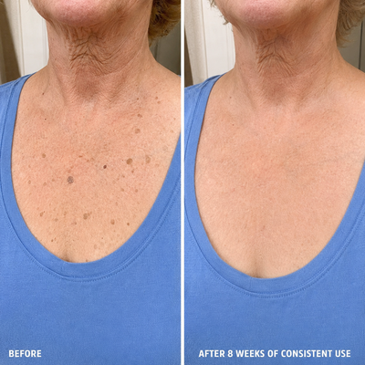 SomaSkin Advanced Keratolytic Cream