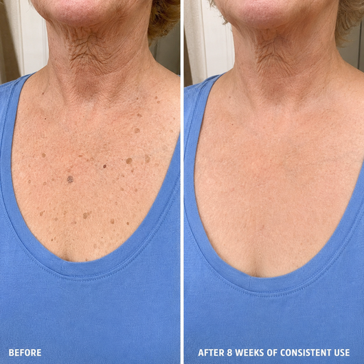 SomaSkin Advanced Keratolytic Cream