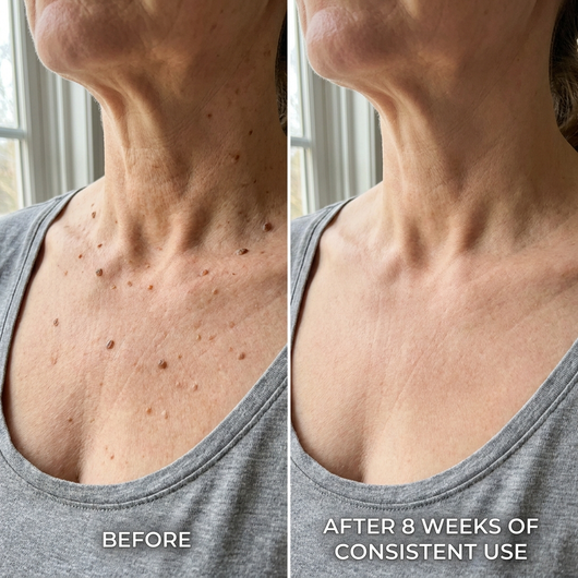 SomaSkin Advanced Keratolytic Cream