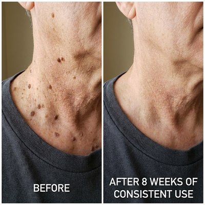 SomaSkin Advanced Keratolytic Cream